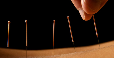 Acupuncture needles being plaecd in back